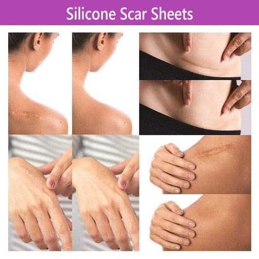 Silicone Gel Sheets for Scar